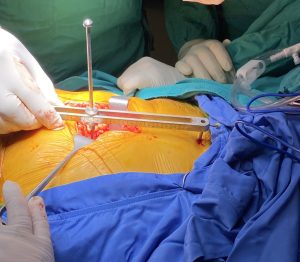 Kalça protez ameliyatı esnasında bacak boyunun ölçülmesi için kullanılan ölçüm cihazı